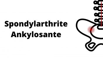 Spondylarthrite Ankylosante