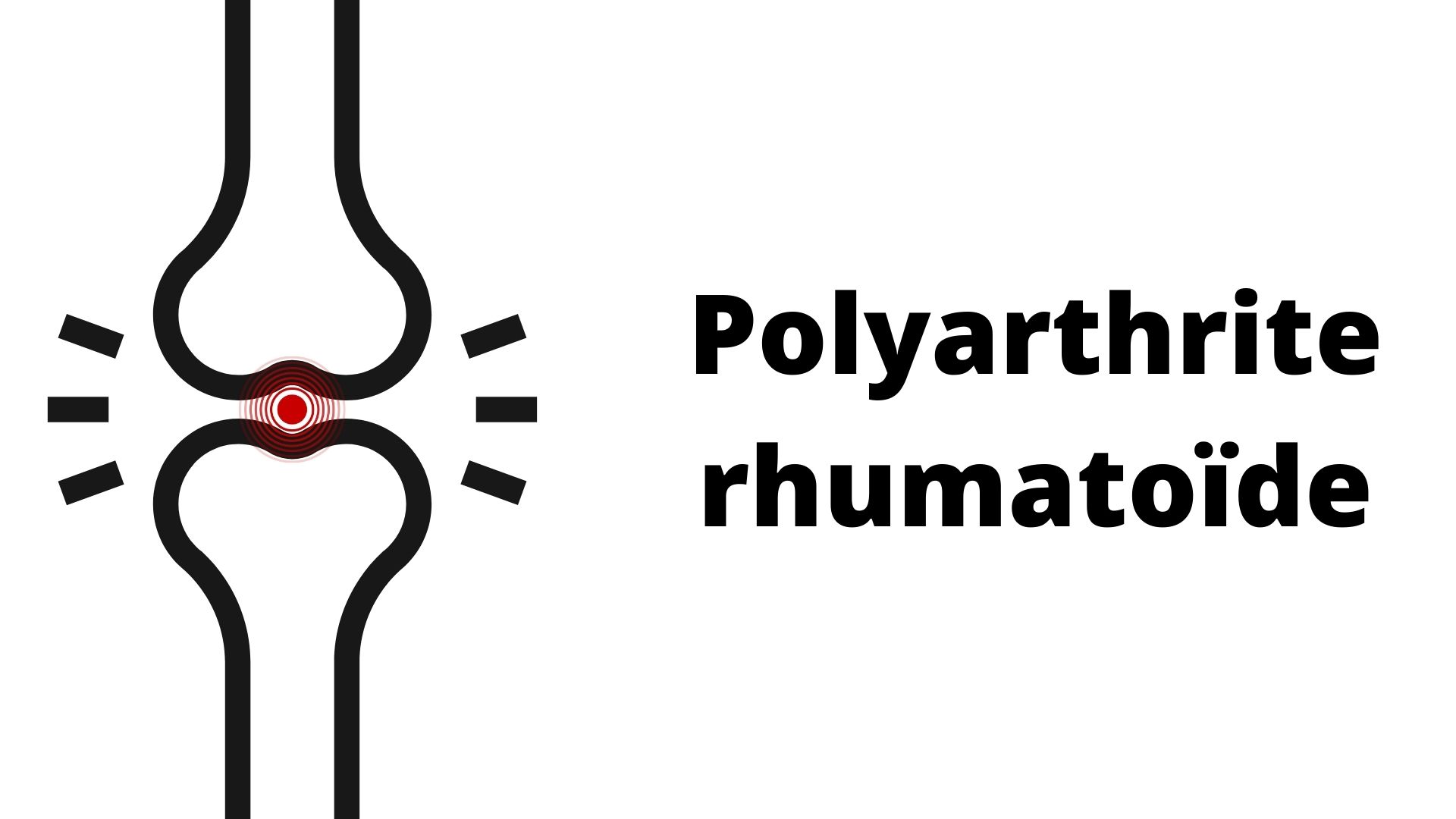 Ergonomie du poste de travail - La polyarthrite rhumatoïde