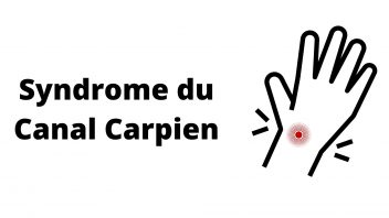 Syndrome Canal Carpien